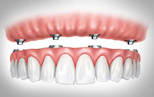 illustration of upper set of denture implants