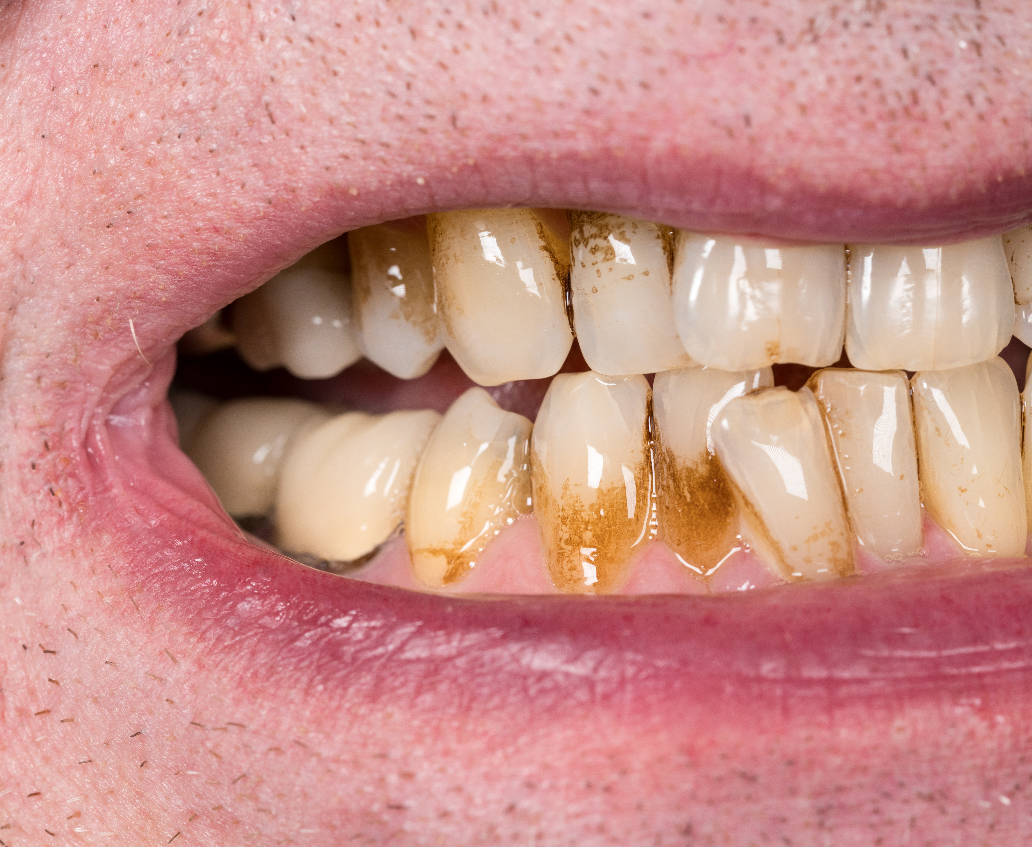 Gum Recession - Moorestown, NJ & Medford, NJ - Ossseous Surgery